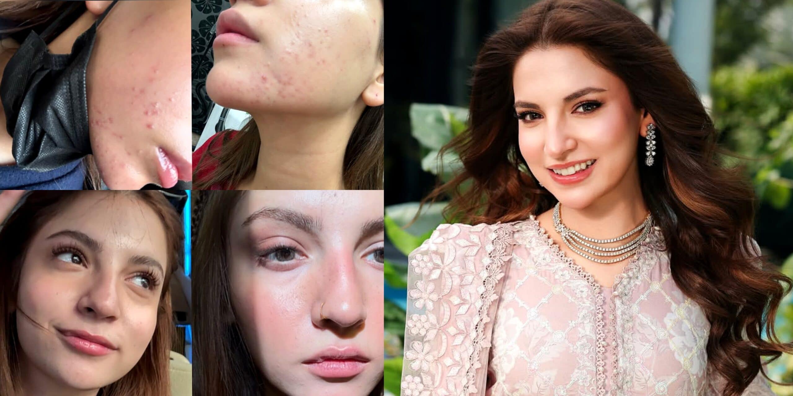 Dananeer Mobeen Gets Real About Her Skin Struggles and Acne